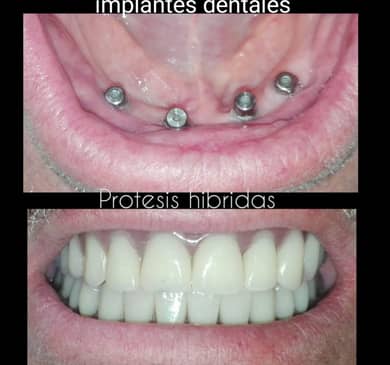 Slider image (10) Dental Implants in Colombia Dr Johanna Calderon